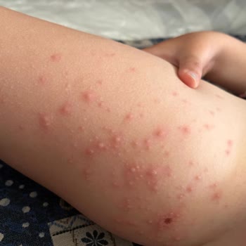 Selge Beach Resort Spa Çocuğumuz Havuzdan El-ayak Hastalığı Kaptı Hijyen Büyük Risk Taşıyor