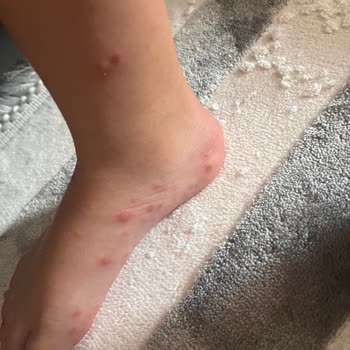 Selge Beach Resort Spa Çocuğumuz Havuzdan El-ayak Hastalığı Kaptı Hijyen Büyük Risk Taşıyor