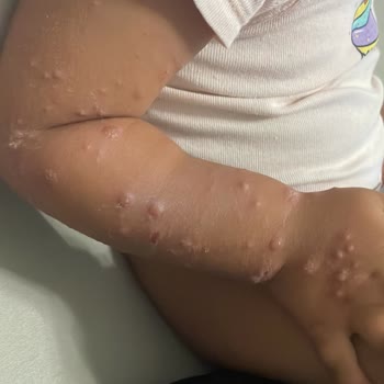 Otel Havuzundan Bulaşan Hastalık Ve Hijyen Eksikliği Nedeniyle Mağduriyet Yaşadık