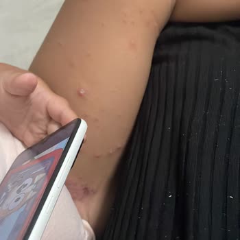 Otel Havuzundan Bulaşan Hastalık Ve Hijyen Eksikliği Nedeniyle Mağduriyet Yaşadık