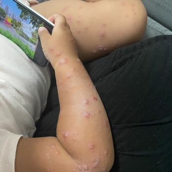 Otel Havuzundan Bulaşan Hastalık Ve Hijyen Eksikliği Nedeniyle Mağduriyet Yaşadık