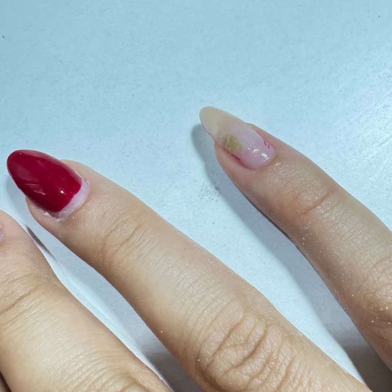 Protez Tırnak Sonrası Mantar Oluştu Mağduriyetim Giderilmiyor