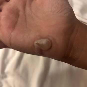 Otelin İhmali Sonucu Kızımın Yanması Ve Yönetimin İlgisizliği