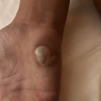 Otelin İhmali Sonucu Kızımın Yanması Ve Yönetimin İlgisizliği