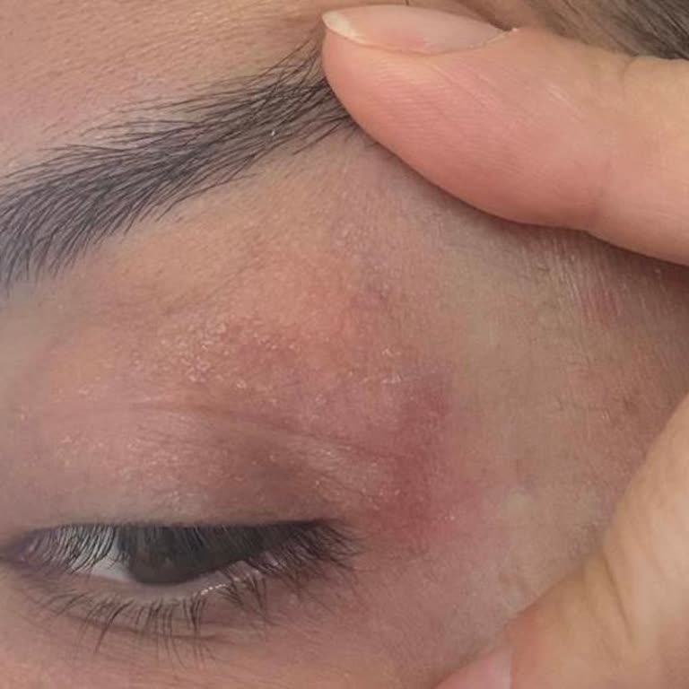 L'Loreal Paris Revitalift Güneş Kremi Cildimde Sivilce Ve Kuruluk Yaptı