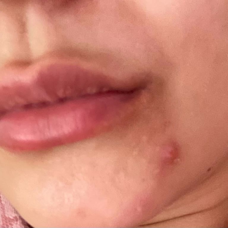 Kullandığım Serum Cildimde Ağrılı Sivilce Ve Şişlik Yaptı, Rengi Ve Kokusu Değişmiş