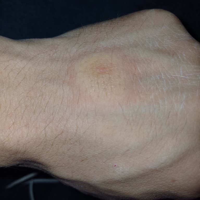 Apranax Ford Sonrası Ciddi Alerjik Reaksiyon Ve Uyarı Eksikliği