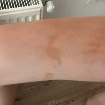 Sunozon Bronzlaştırıcı Yağ Cildimde Kalıcı Lekeler Oluşturdu, Tatilim Mahvoldu!