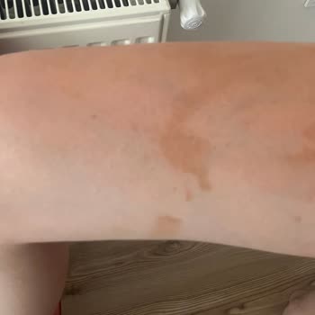 Sunozon Bronzlaştırıcı Yağ Cildimde Kalıcı Lekeler Oluşturdu, Tatilim Mahvoldu!