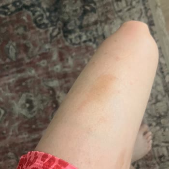 Sunozon Bronzlaştırıcı Yağ Cildimde Kalıcı Lekeler Oluşturdu, Tatilim Mahvoldu!