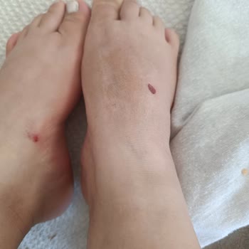 Bambi Ayakkabı İlk Kullanımda Yaralanmaya Sebep Olan Terlik İçin İade Talebi