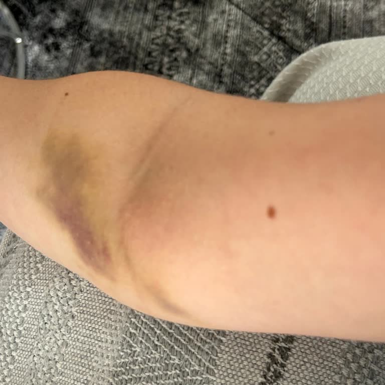 Acil Serviste Uygulanan Serum Sonrası Kolumda Kalıcı Sorunlar Ve İlgisiz Personel