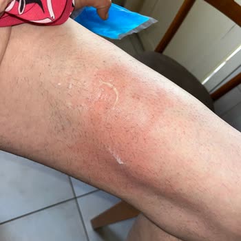 Aldığım Cam Kupa Masada Patladı, Annem Yanıkla Hastaneye Kaldırıldı!