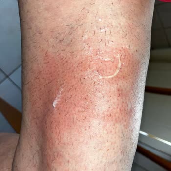 Aldığım Cam Kupa Masada Patladı, Annem Yanıkla Hastaneye Kaldırıldı!