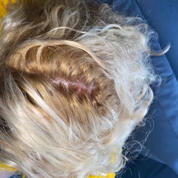 Saç Boyası Saç Diplerimde Ciddi Yanık Ve Kanamaya Neden Oldu