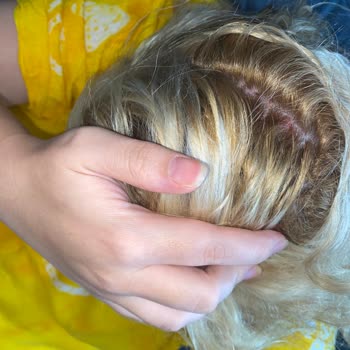 Saç Boyası Saç Diplerimde Ciddi Yanık Ve Kanamaya Neden Oldu