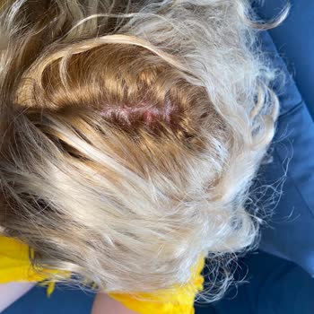 Saç Boyası Saç Diplerimde Ciddi Yanık Ve Kanamaya Neden Oldu