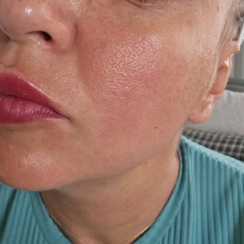 Watsons Micellar Temizleme Suyu Cildimde Yanma Ve Tahrişe Sebep Oldu