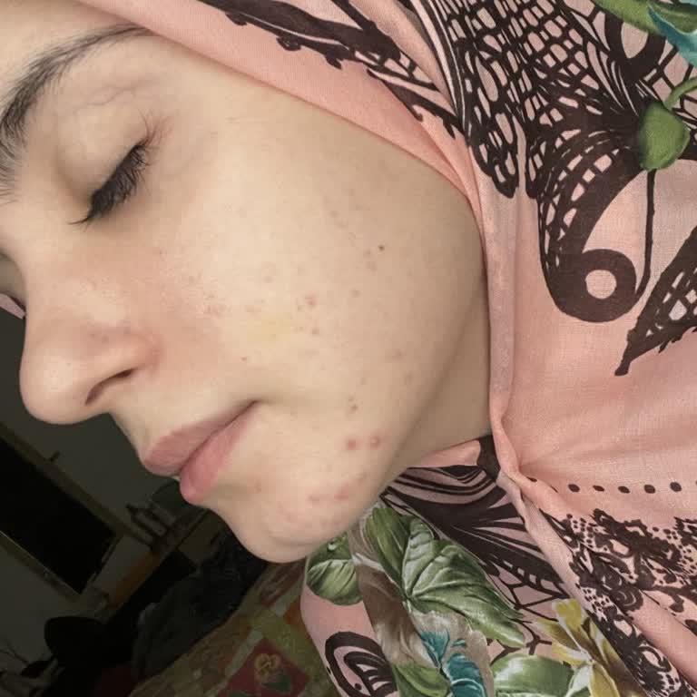 Yüz Mezoterapisi Sonrası Mağduriyet Ve Tehdit Edilme