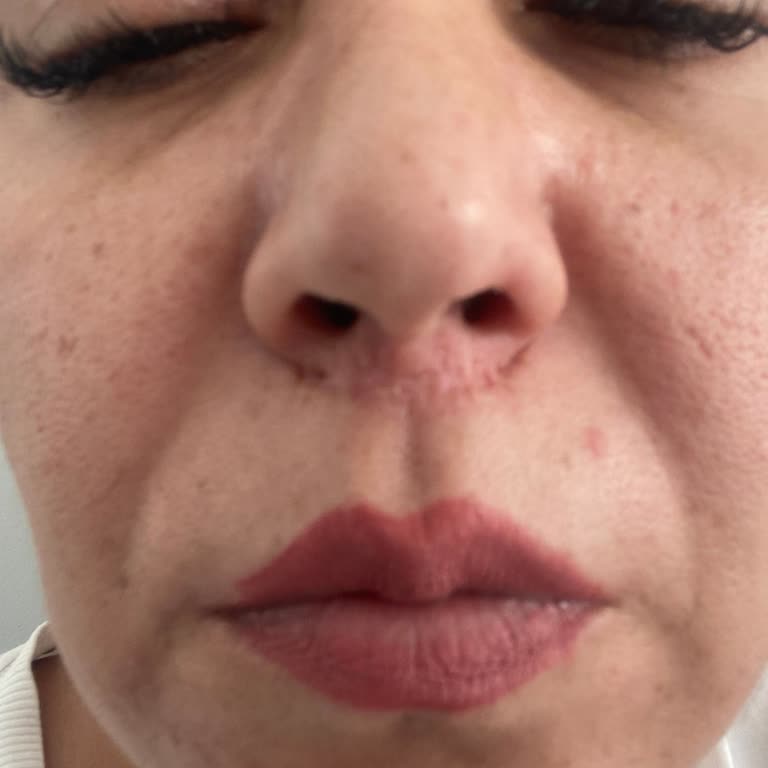 Liplift Ameliyatı Sonrası İzler Geçmedi, Ücret İadesi Talep Ediyorum