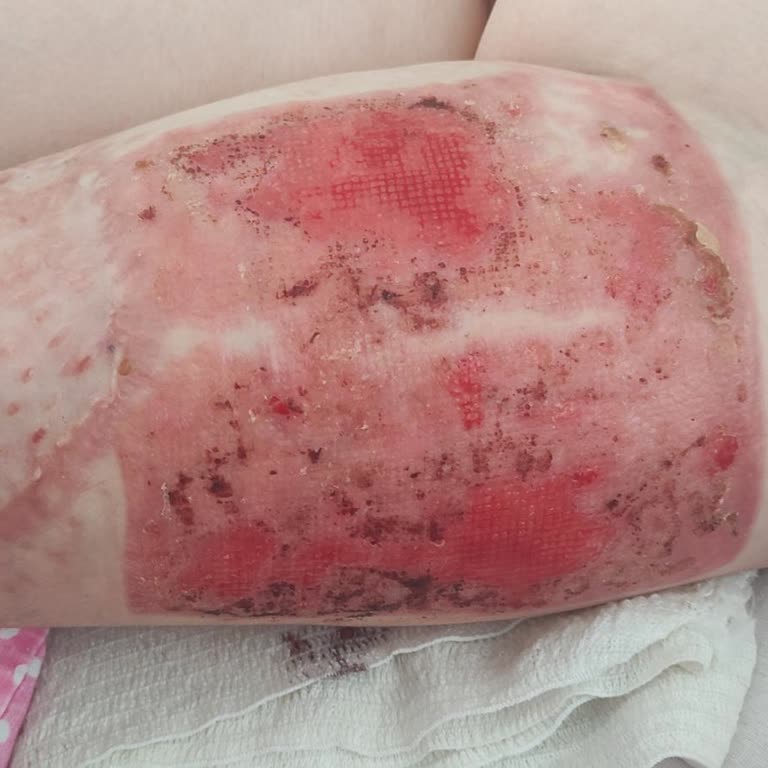 Kızımın Trafik Kazası Sonrası Refakatçi Raporu Talebimin Hastane Tarafından Karşılanmaması