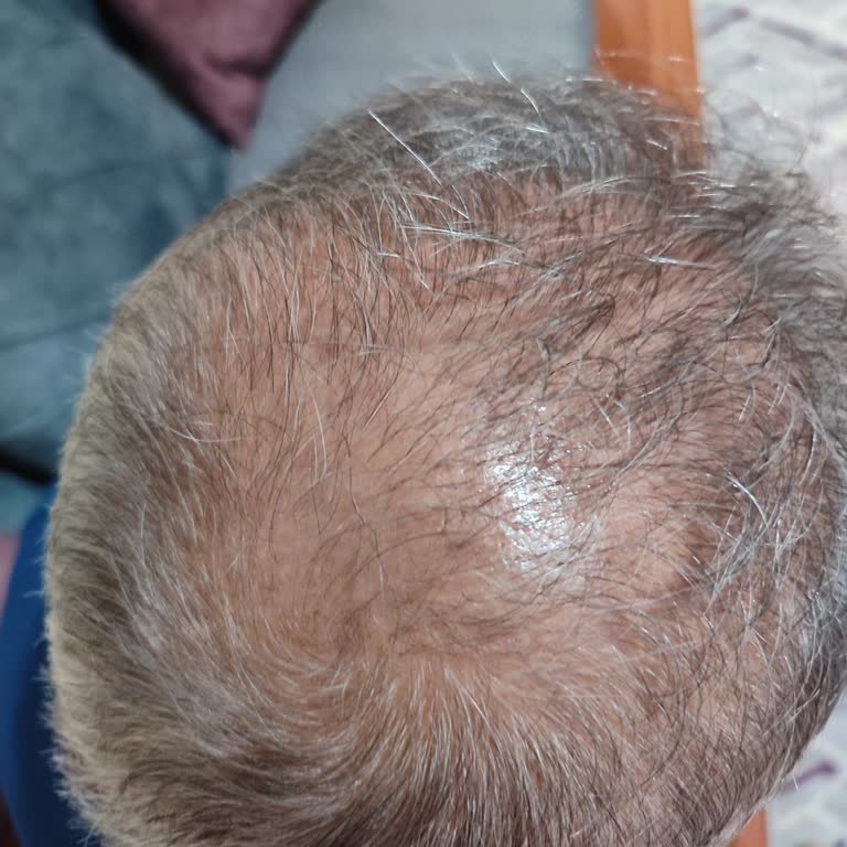 Saç Ekimi Sonrası Sonuçsuz İşlemler Ve Ücret İadesi Talebi