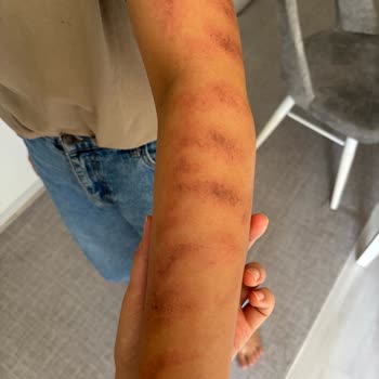 Güzellik Merkezinde Tekrarlayan Yanık Ve İlgisiz Davranışlar