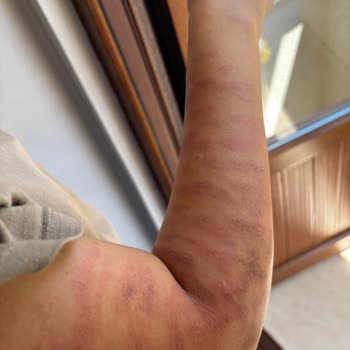 Güzellik Merkezinde Tekrarlayan Yanık Ve İlgisiz Davranışlar