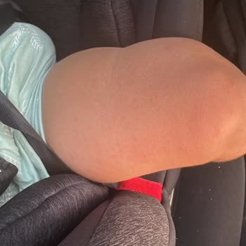 Otelin Hijyen Eksikliği Nedeniyle Bebeğimiz Ağır Enfeksiyon Kaptı