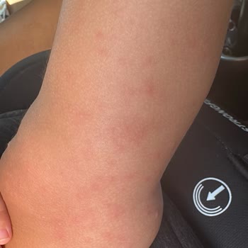 Otelin Hijyen Eksikliği Nedeniyle Bebeğimiz Ağır Enfeksiyon Kaptı