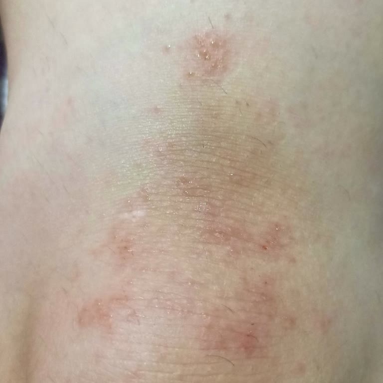 Baga External Genital Area Whitening Cream Kaşıntı Yaptı