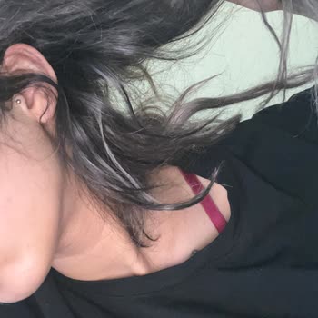 Mikro Kaynak Sonrası Saçlarım Döküldü, Mağduriyetim Giderilmiyor