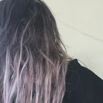 Mikro Kaynak Sonrası Saçlarım Döküldü, Mağduriyetim Giderilmiyor