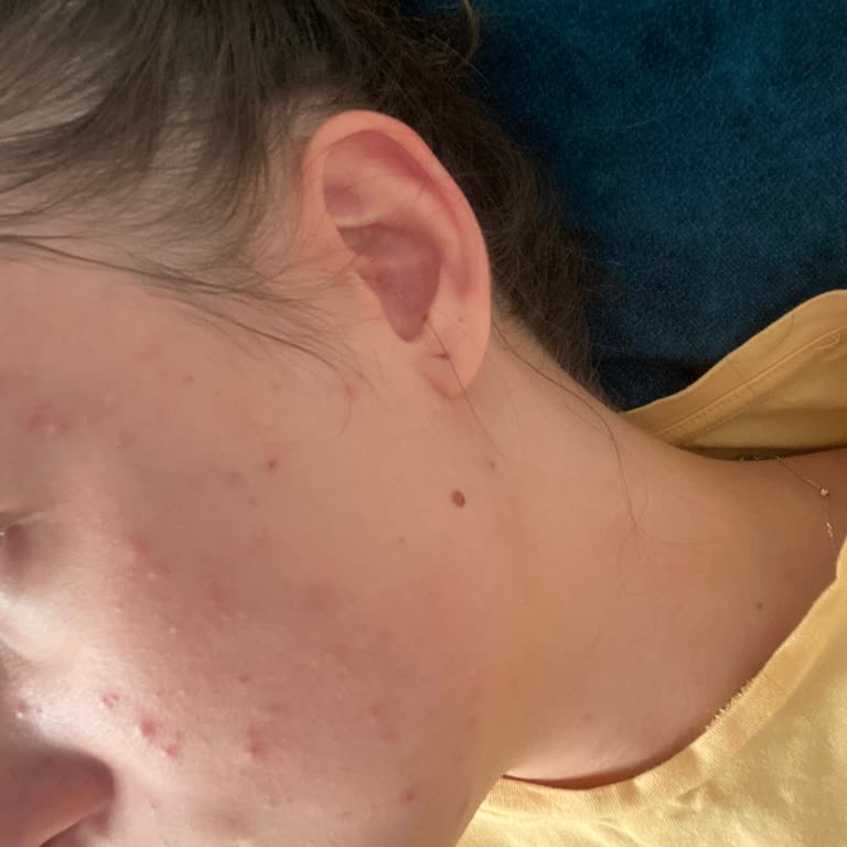 Yves Rocher Tonik Sonrası Yoğun Sivilce Problemi Yaşadım