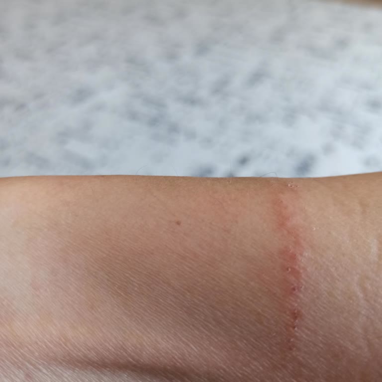 Alerji Yapan Takı Ve Yetersiz Destekle Mağduriyet