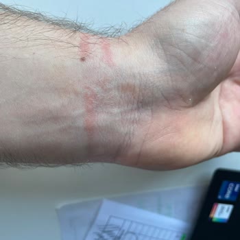 Huawei Band 9 Kullanımı Sonrası Cilt Reaksiyonu Ve Yetersiz Müşteri Desteği