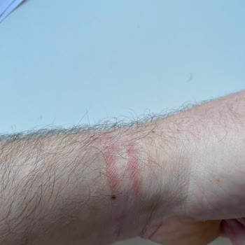 Huawei Band 9 Kullanımı Sonrası Cilt Reaksiyonu Ve Yetersiz Müşteri Desteği
