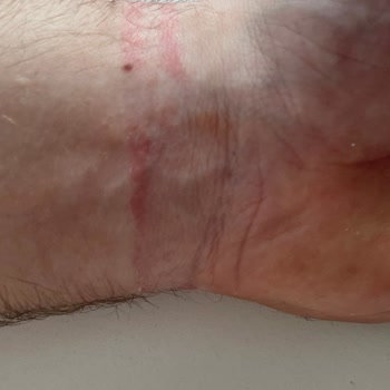 Huawei Band 9 Kullanımı Sonrası Cilt Reaksiyonu Ve Yetersiz Müşteri Desteği