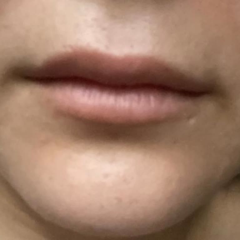 Dudak Dolgusu Sonrası Sonuç Alamadım, Ücret İadesi Yapılmadı