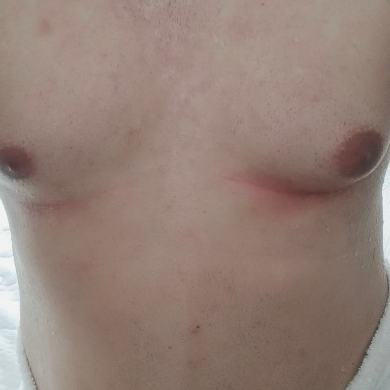 Sesu Tüy Dökücü Sprey Göğsümde Ciddi Yanma Ve Kabarmaya Yol Açtı