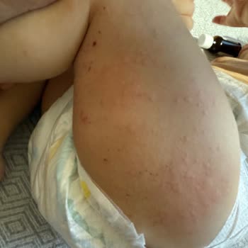 Bebek Losyonunda Ciddi Yan Etkiler Ve Güvenlik Endişesi