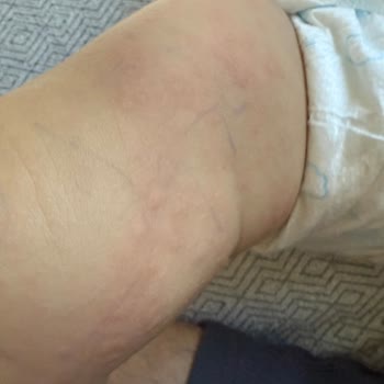 Bebek Losyonunda Ciddi Yan Etkiler Ve Güvenlik Endişesi