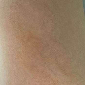 Nur Kamuflaj Makyaj Çatlak Tedavisi Sonrası Bacaklarımda Kalıcı İzler Ve Mağduriyet