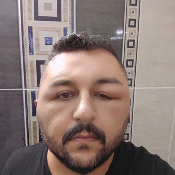 Ostwint Beyaz Giderici Ürünü Kafa Derimde Enfeksiyona Yol Açtı, Önlem Alınmalı