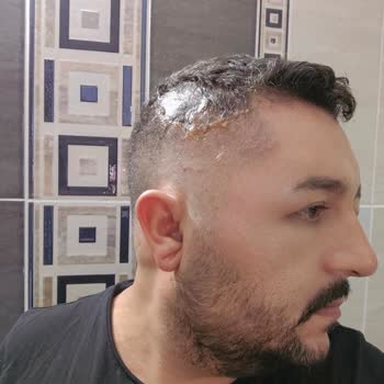 Ostwint Beyaz Giderici Ürünü Kafa Derimde Enfeksiyona Yol Açtı, Önlem Alınmalı