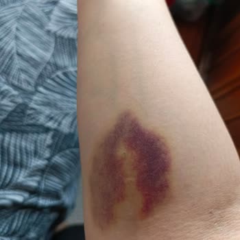 Nefroloji Bölümünde Özensiz İşlem Ve İlgisiz Personel Nedeniyle Mağduriyet Yaşadım