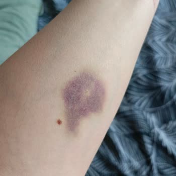 Nefroloji Bölümünde Özensiz İşlem Ve İlgisiz Personel Nedeniyle Mağduriyet Yaşadım