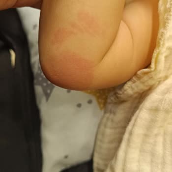 Islak Mendil Bebeğimde Alerji Ve Mantar Yaptı Endişeliyim