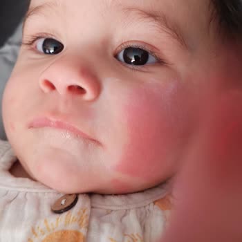 Islak Mendil Bebeğimde Alerji Ve Mantar Yaptı Endişeliyim