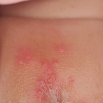 Islak Mendil Bebeğimde Alerji Ve Mantar Yaptı Endişeliyim